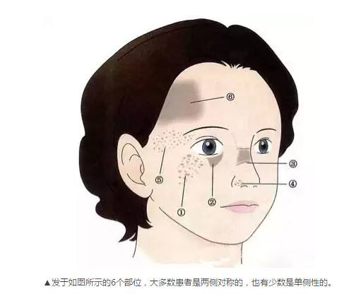 有一些如果是单发的褐青色痣,伴有黄褐斑的话,它的治愈可能就没有单纯