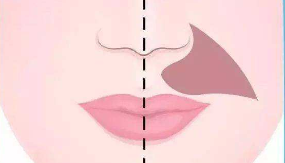 自体脂肪垫鼻根可以吗?效果怎么样!